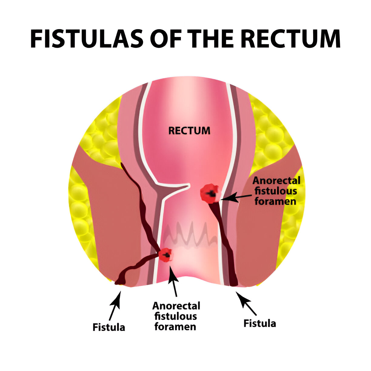 Anal Fistula